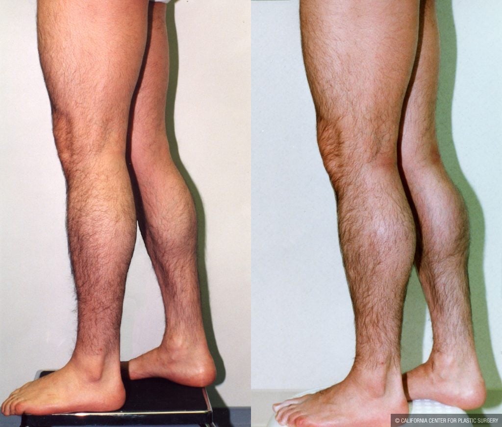 Calf Augmentation Before & After Patient #10912