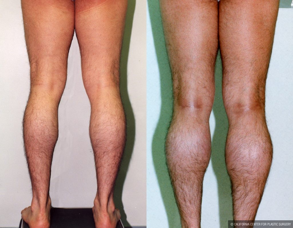 Calf Augmentation Before & After Patient #10912