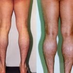 Calf Augmentation Before & After Patient #10912
