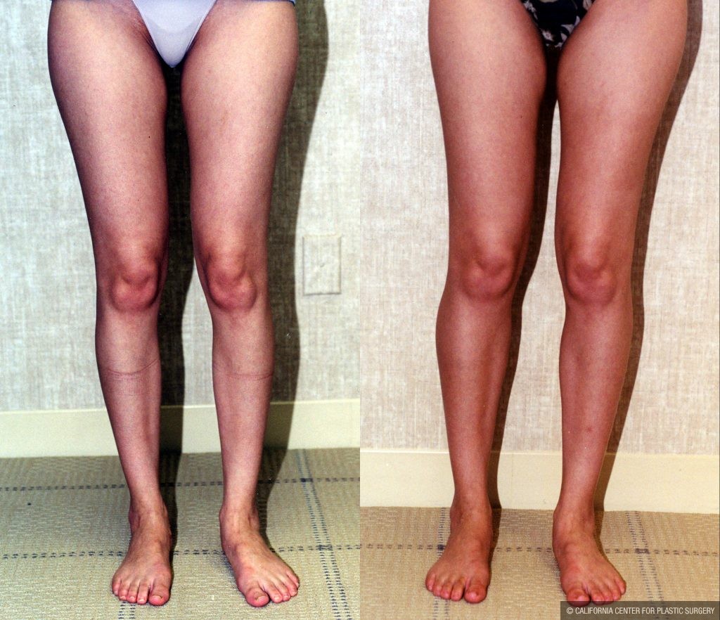 Calf Augmentation Before & After Patient #10916