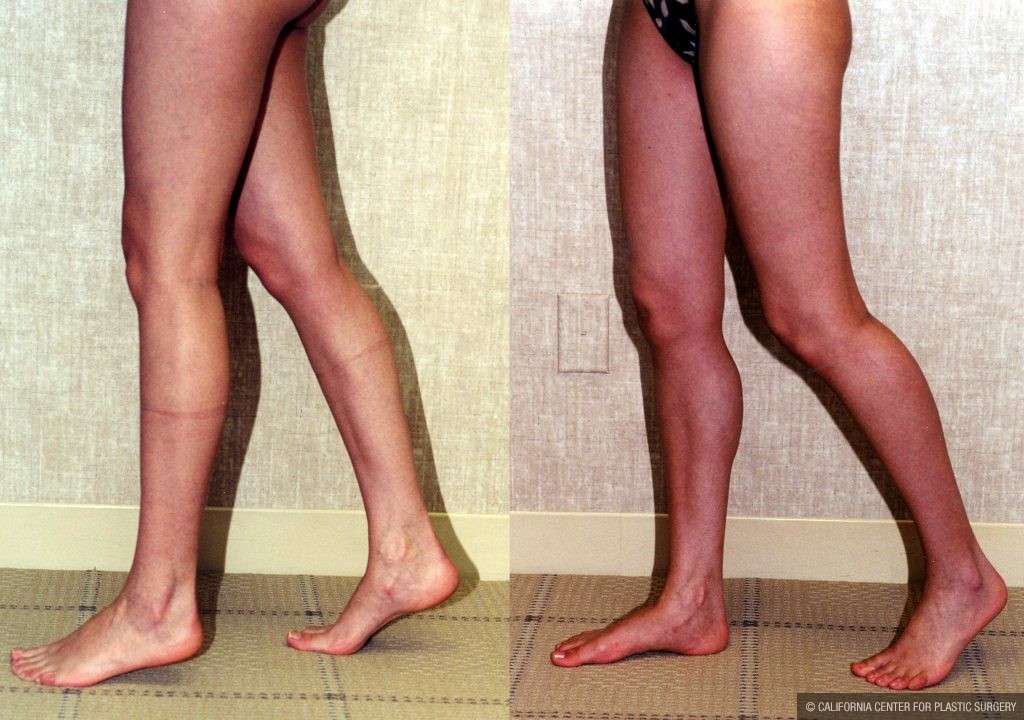 Calf Augmentation Before & After Patient #10916