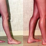 Calf Augmentation Before & After Patient #10916