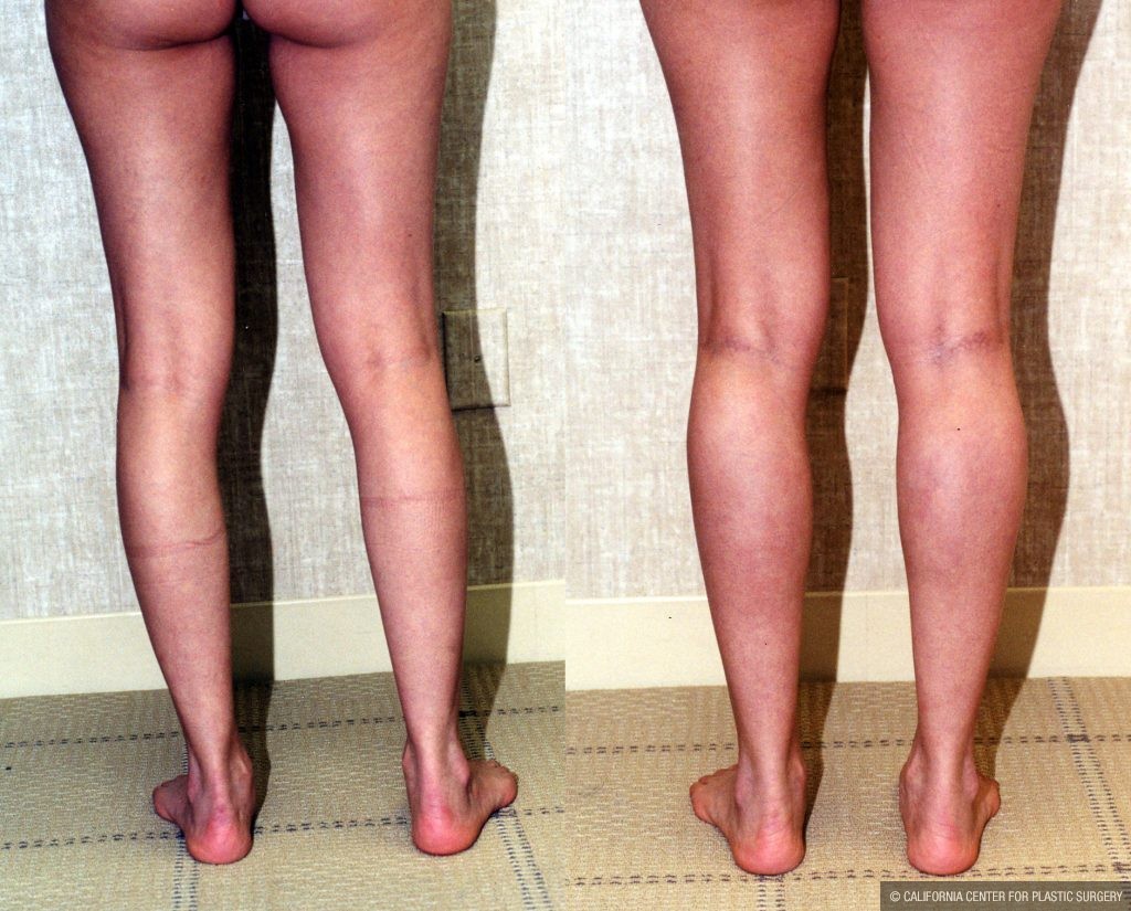 Calf Augmentation Before & After Patient #10916
