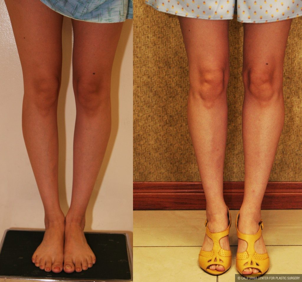 Calf Augmentation Before & After Patient #10855
