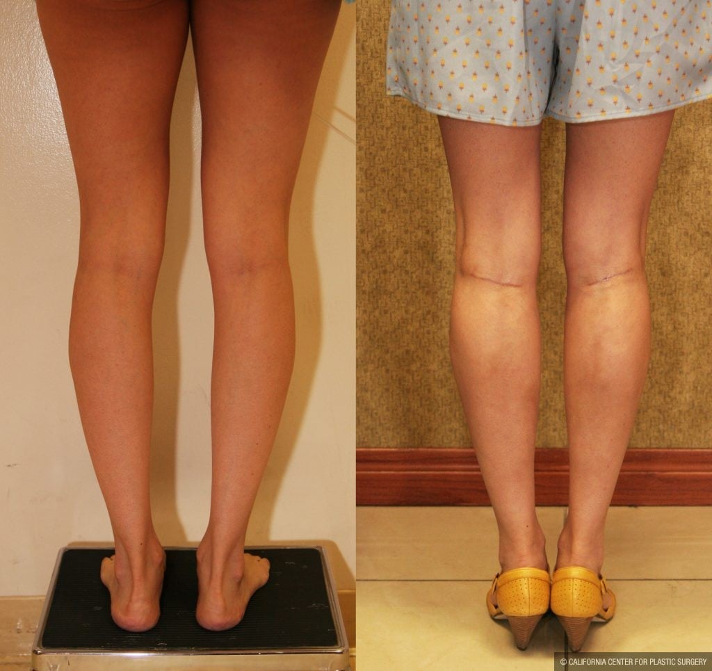 Calf Augmentation Before & After Patient #10855