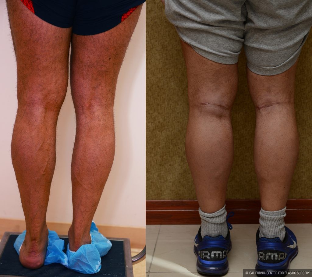 Calf Augmentation Before & After Patient #10860