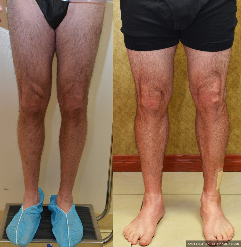 Calf Augmentation Before & After Patient #10873