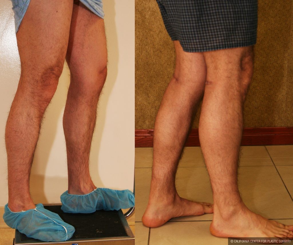 Calf Augmentation Before & After Patient #10877
