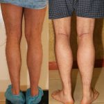 Calf Augmentation Before & After Patient #10877