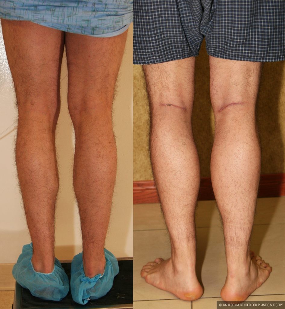 Calf Augmentation Before & After Patient #10877