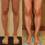 Calf Augmentation Before & After Patient #10888