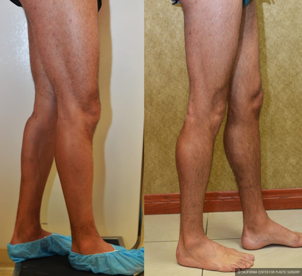 Calf Augmentation Before & After Patient #10881