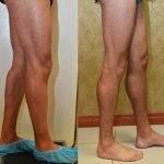 Calf Augmentation Before & After Patient #10881