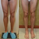 Calf Augmentation Before & After Patient #10881