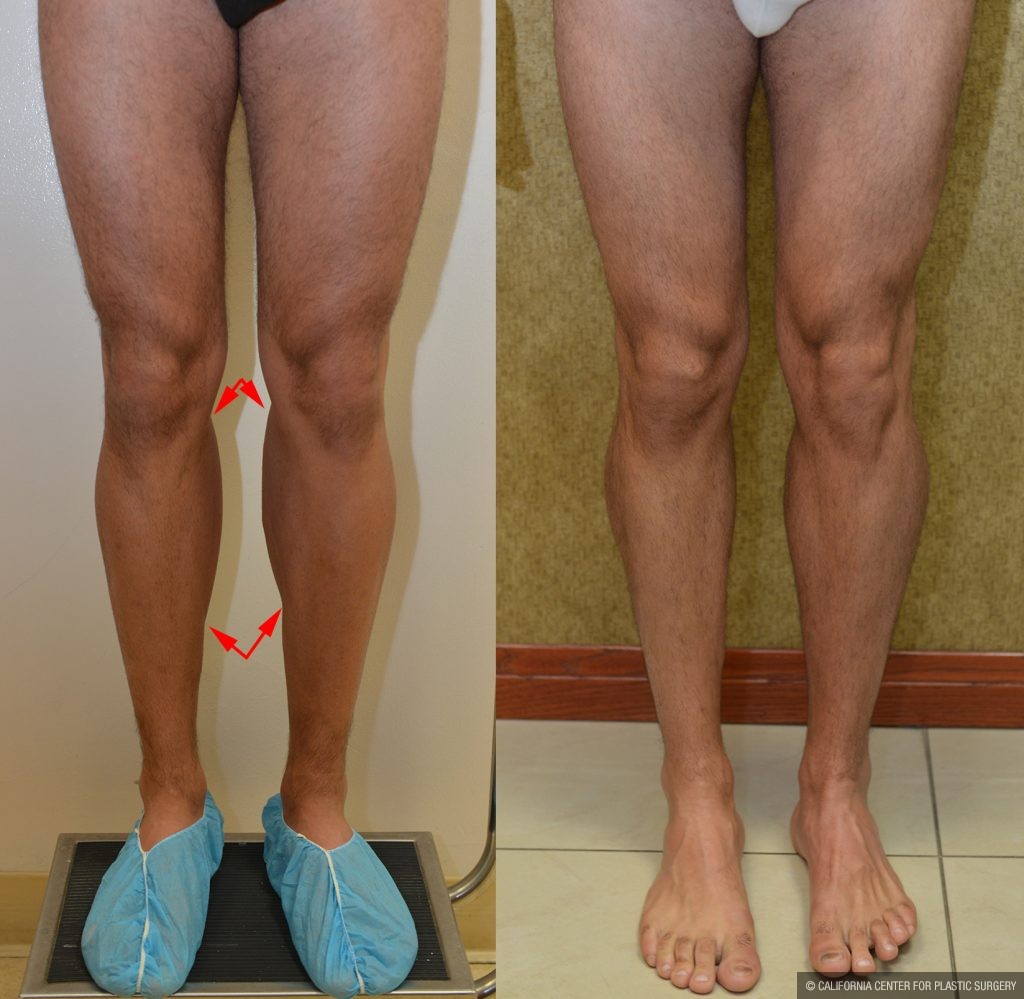 Calf Augmentation Before & After Patient #10881