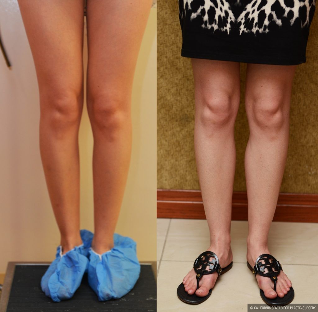 Calf Augmentation Before & After Patient #10897