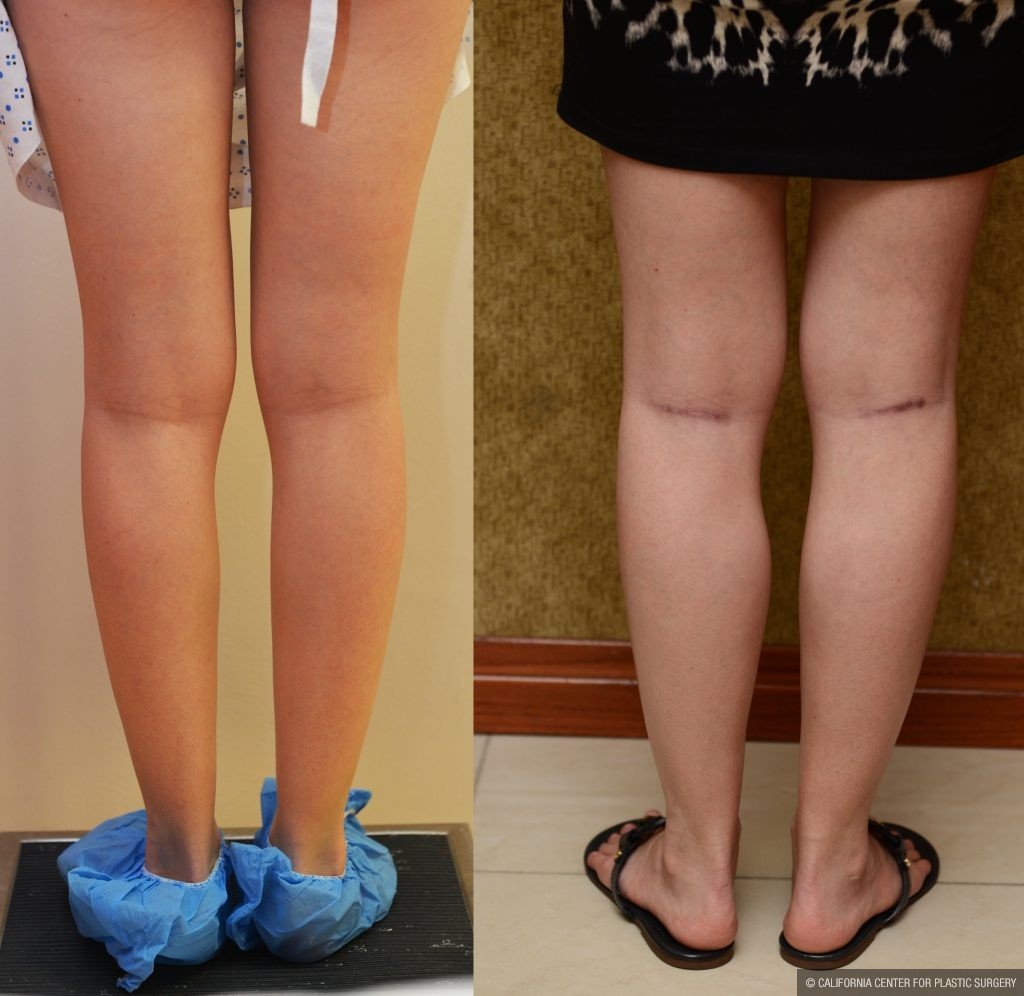 Calf Augmentation Before & After Patient #10897