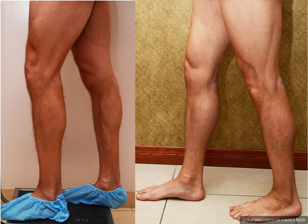 Calf Augmentation Before & After Patient #10901