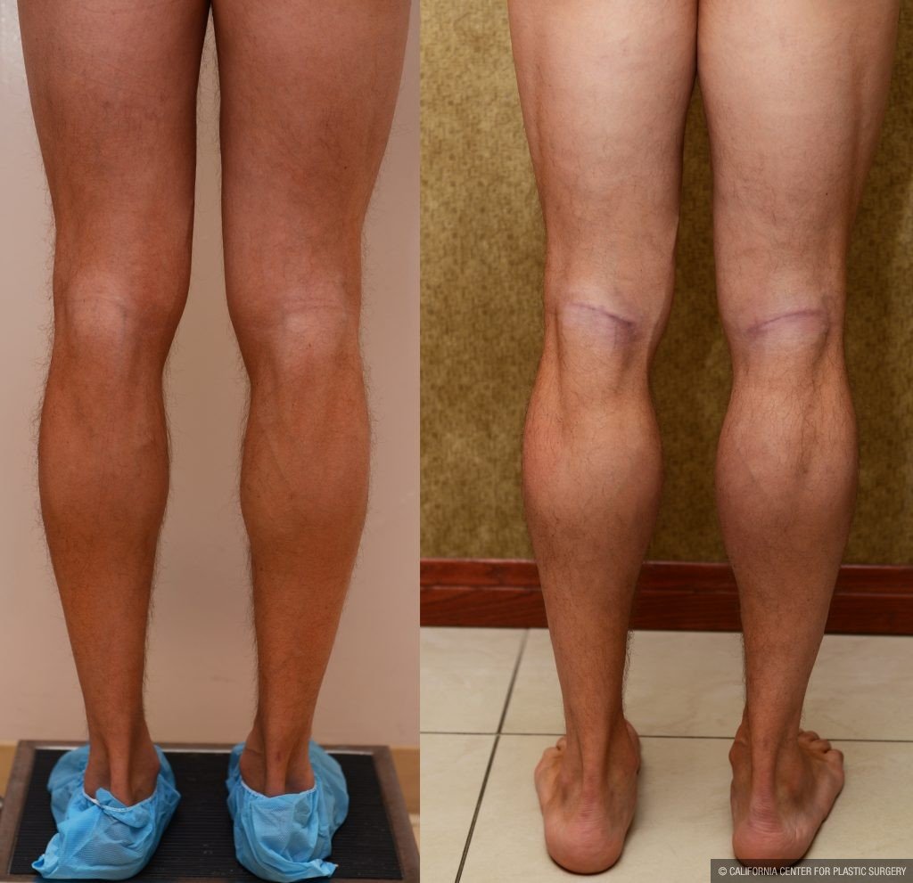 Calf Augmentation Before & After Patient #10901