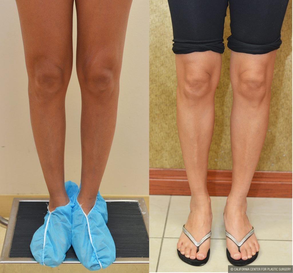 Calf Augmentation Before & After Patient #10906