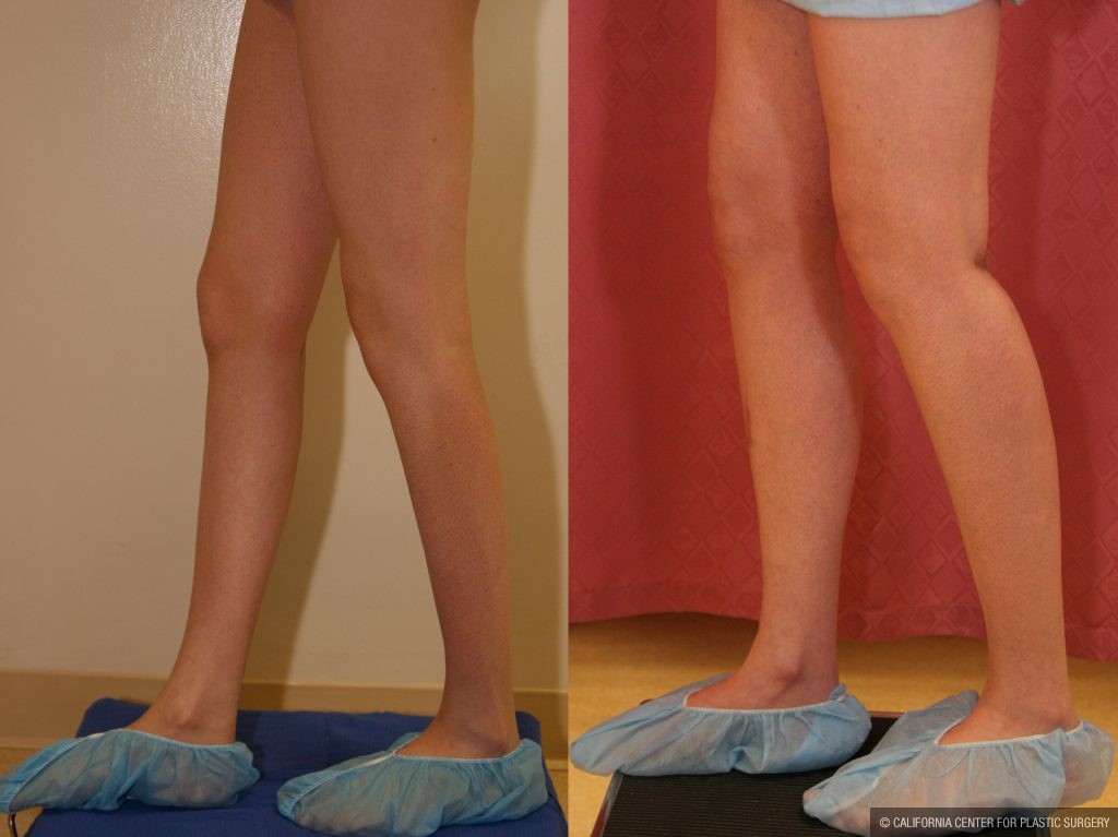 Calf Augmentation Before & After Patient #10851