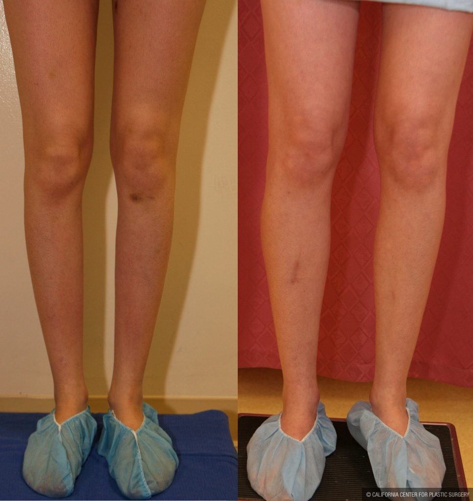 Calf Augmentation Before & After Patient #10851
