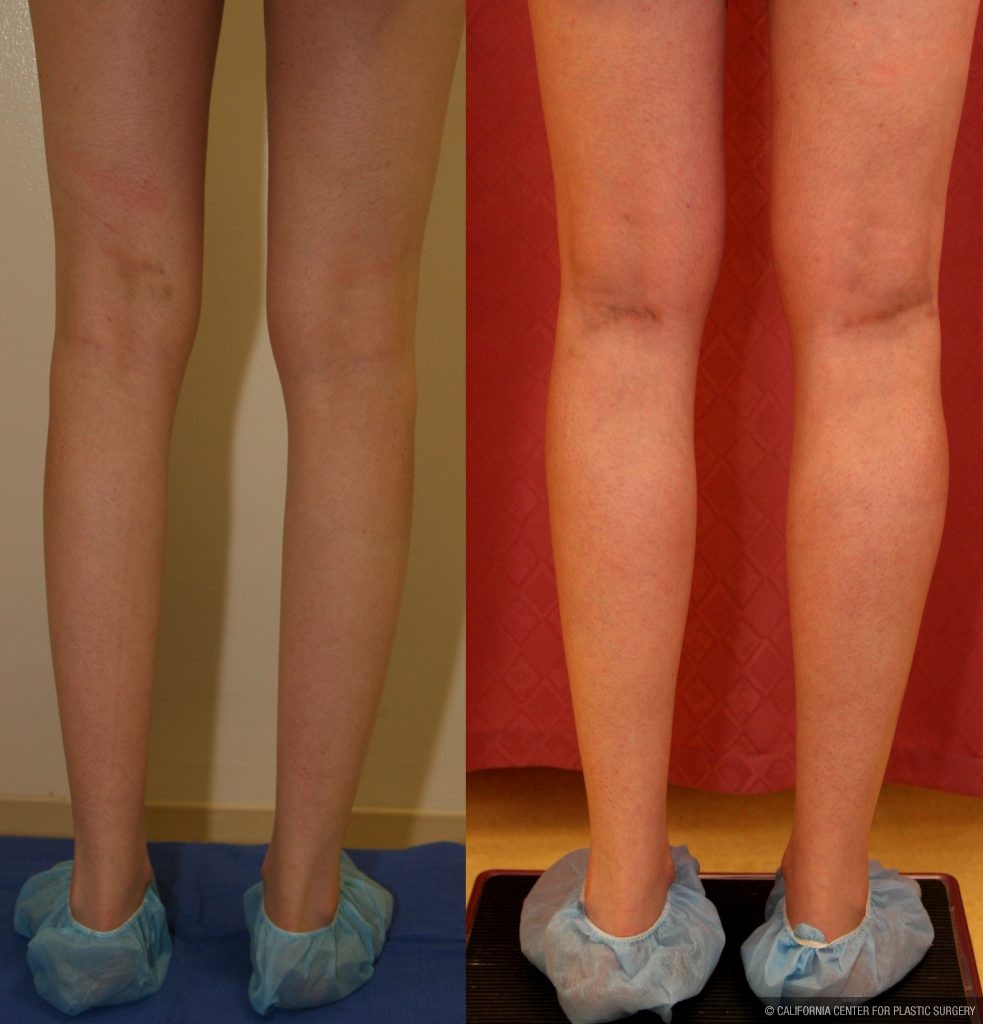 Calf Augmentation Before & After Patient #10851