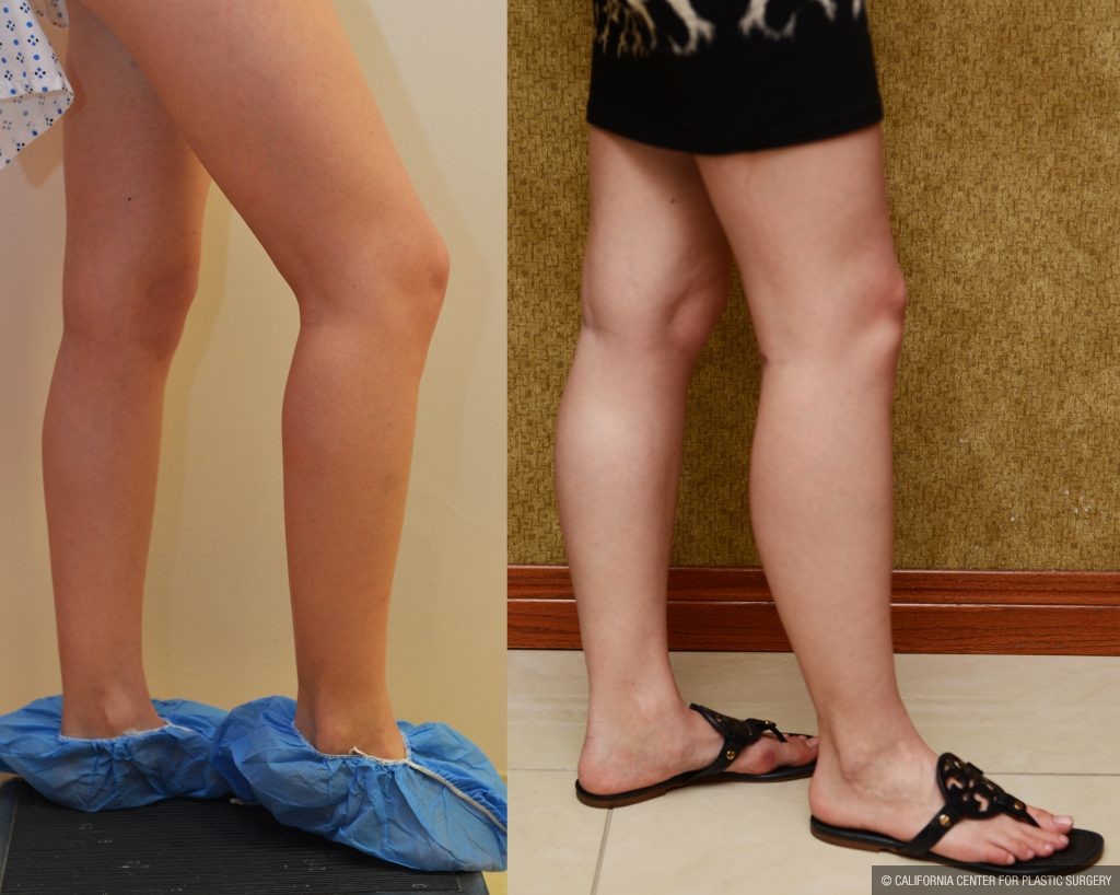 Calf Augmentation Before & After Patient #10897