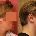 Ear (Otoplasty) Before & After Patient #10922