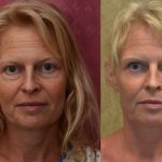 Eyelid (Blepharoplasty) Before & After Patient #10926