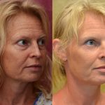 Eyelid (Blepharoplasty) Before & After Patient #10926