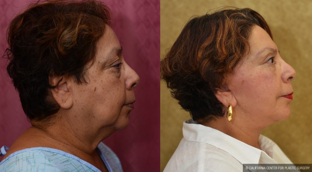 Eyelid (Blepharoplasty) Before & After Patient #10931