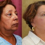 Eyelid (Blepharoplasty) Before & After Patient #10931