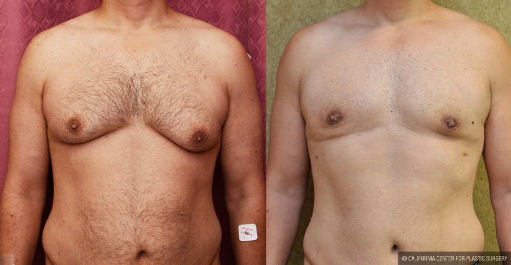 reduction breast california male