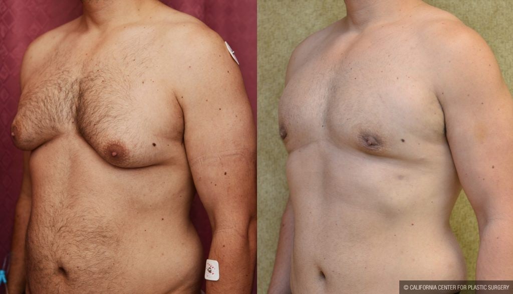 Male gynecomastia (breast) reduction Before & After Patient #10949