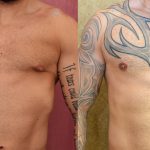 Male gynecomastia (breast) reduction Before & After Patient #10944