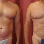 Male gynecomastia (breast) reduction Before & After Patient #10958