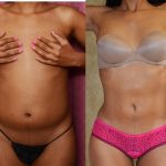 Liposuction Abdomen Medium Before & After Patient #10961