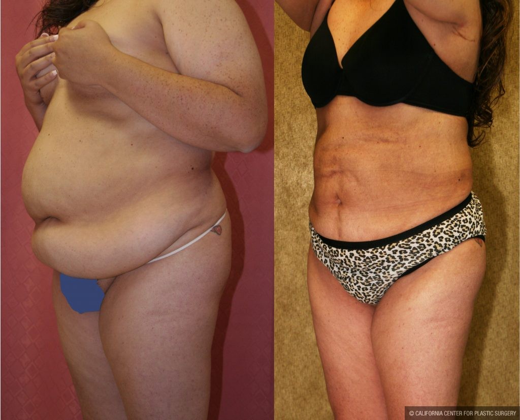 Liposuction Abdomen Plus Size Before & After Patient #10965