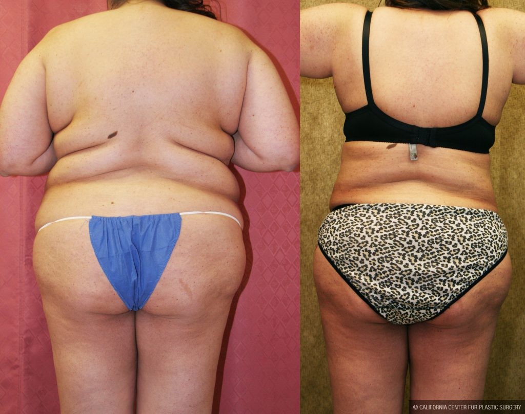 Liposuction Abdomen Plus Size Before & After Patient #10965