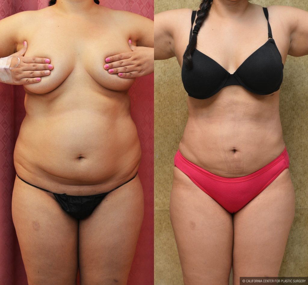 Liposuction Abdomen Plus Size Before & After Patient #10974