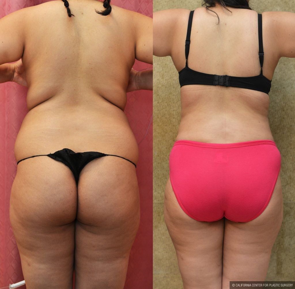 Liposuction Abdomen Plus Size Before & After Patient #10974