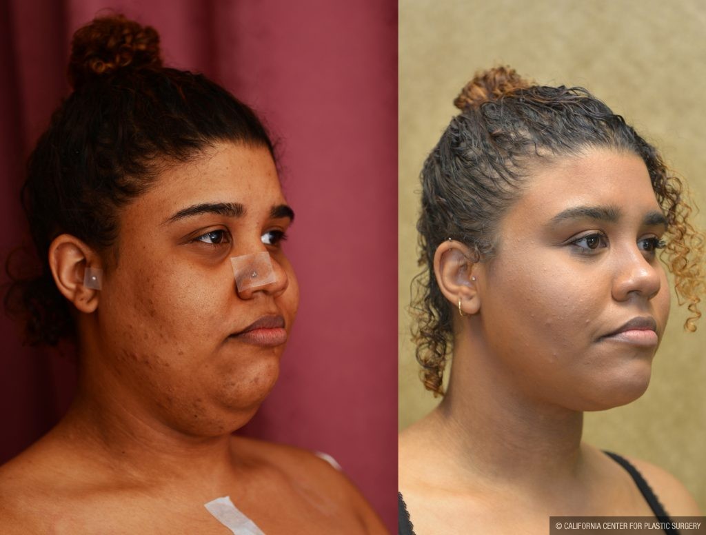 Neck & Face Liposuction Before & After Patient #10985