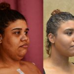 Neck & Face Liposuction Before & After Patient #10985