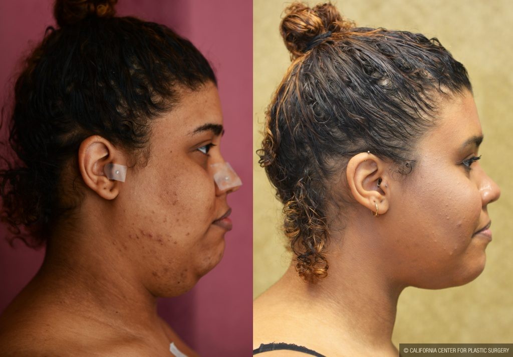 Neck & Face Liposuction Before & After Patient #10985