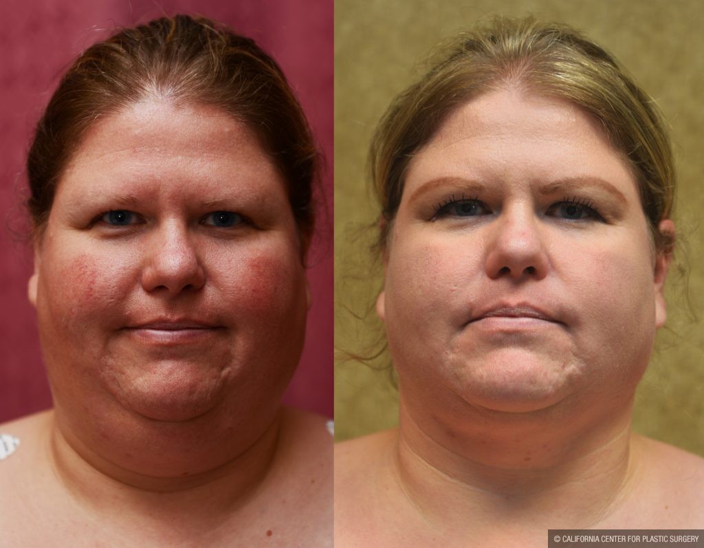 Neck & Face Liposuction Before & After Patient #10993