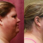 Neck & Face Liposuction Before & After Patient #10993