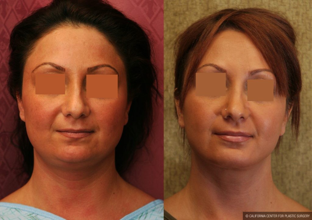 Neck & Face Liposuction Before & After Patient #10989