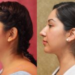 Neck & Face Liposuction Before & After Patient #11005