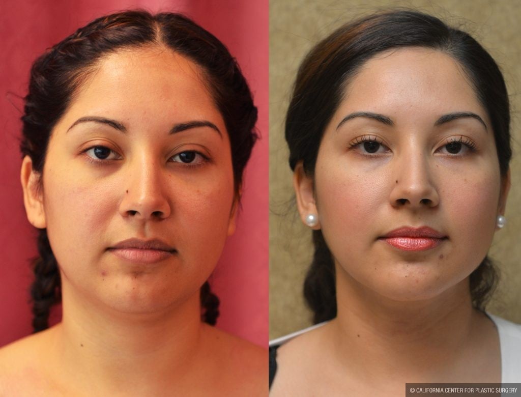 Patient 11005 Neck And Face Liposuction Before And After Photos Encino